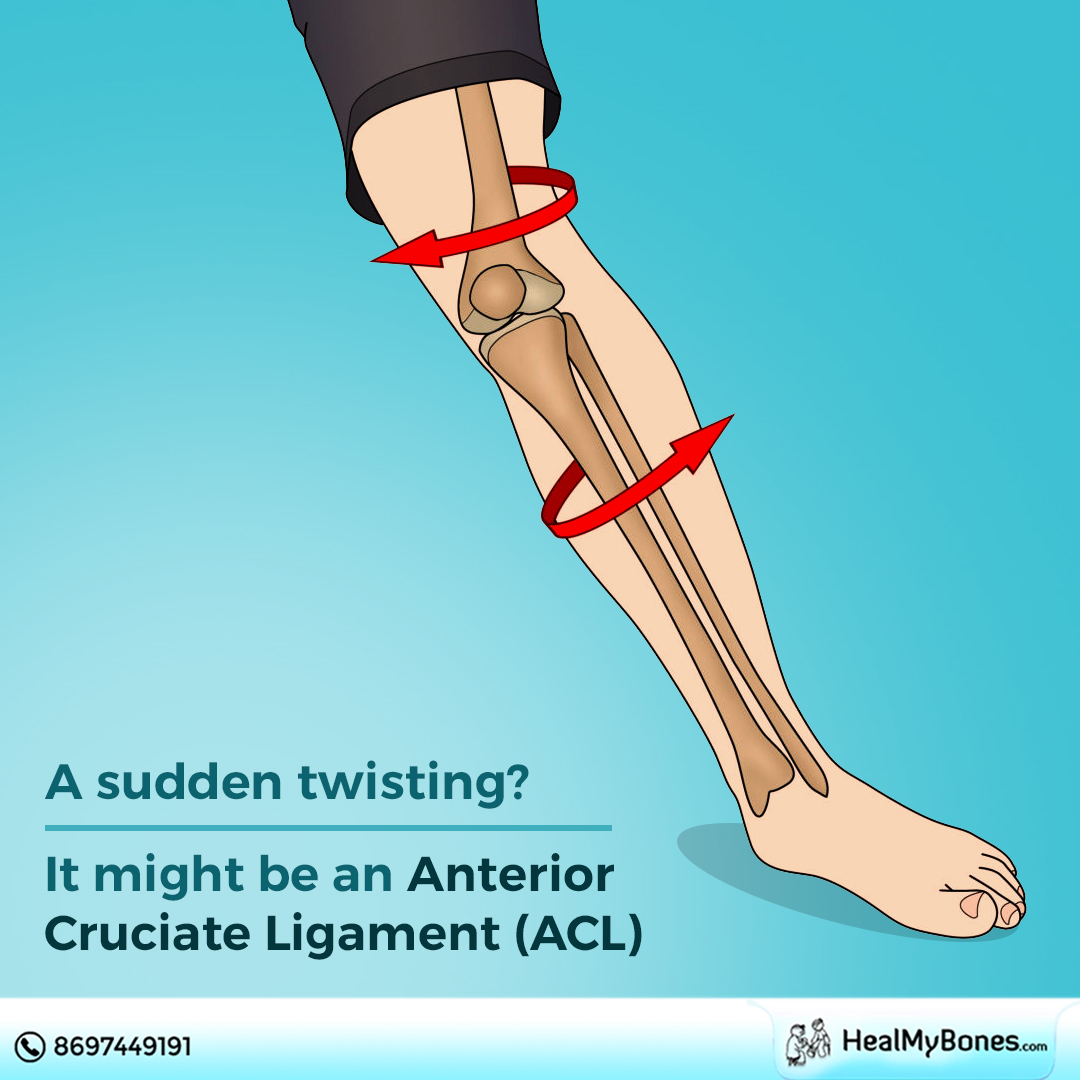 Heal My Bones - An ACL injury is a tear or sprain of the... | Facebook