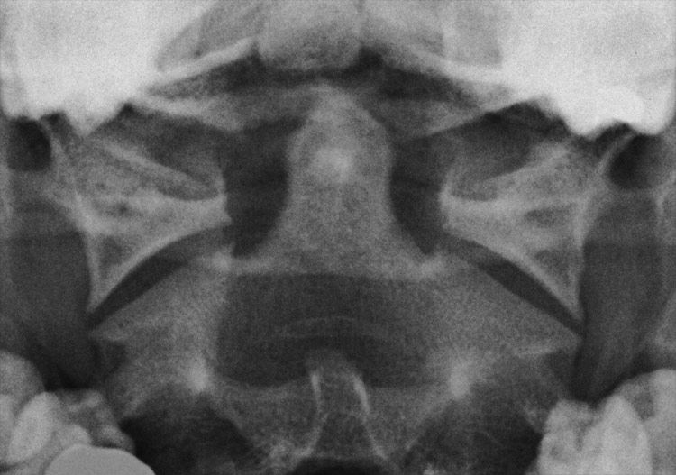 Radiology - X-RAY QUIZ: Flexion/extension injury to neck. Single open ...