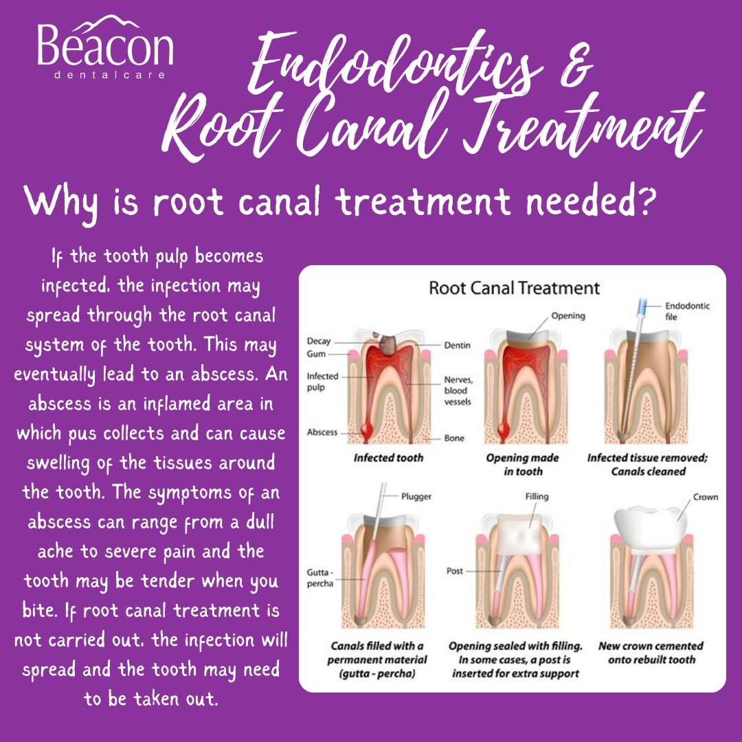 Beacon - Why is root canal treatment needed? If the tooth pulp becomes ...