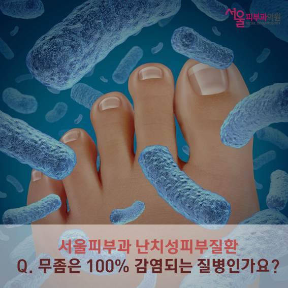 울산 서울에이치피부과 - #무좀 은 피부사상균이라는 곰팡이에 피부가 감염되어 발생합니다. 곰팡이는 습기가 많고 따뜻한 환경을 ...