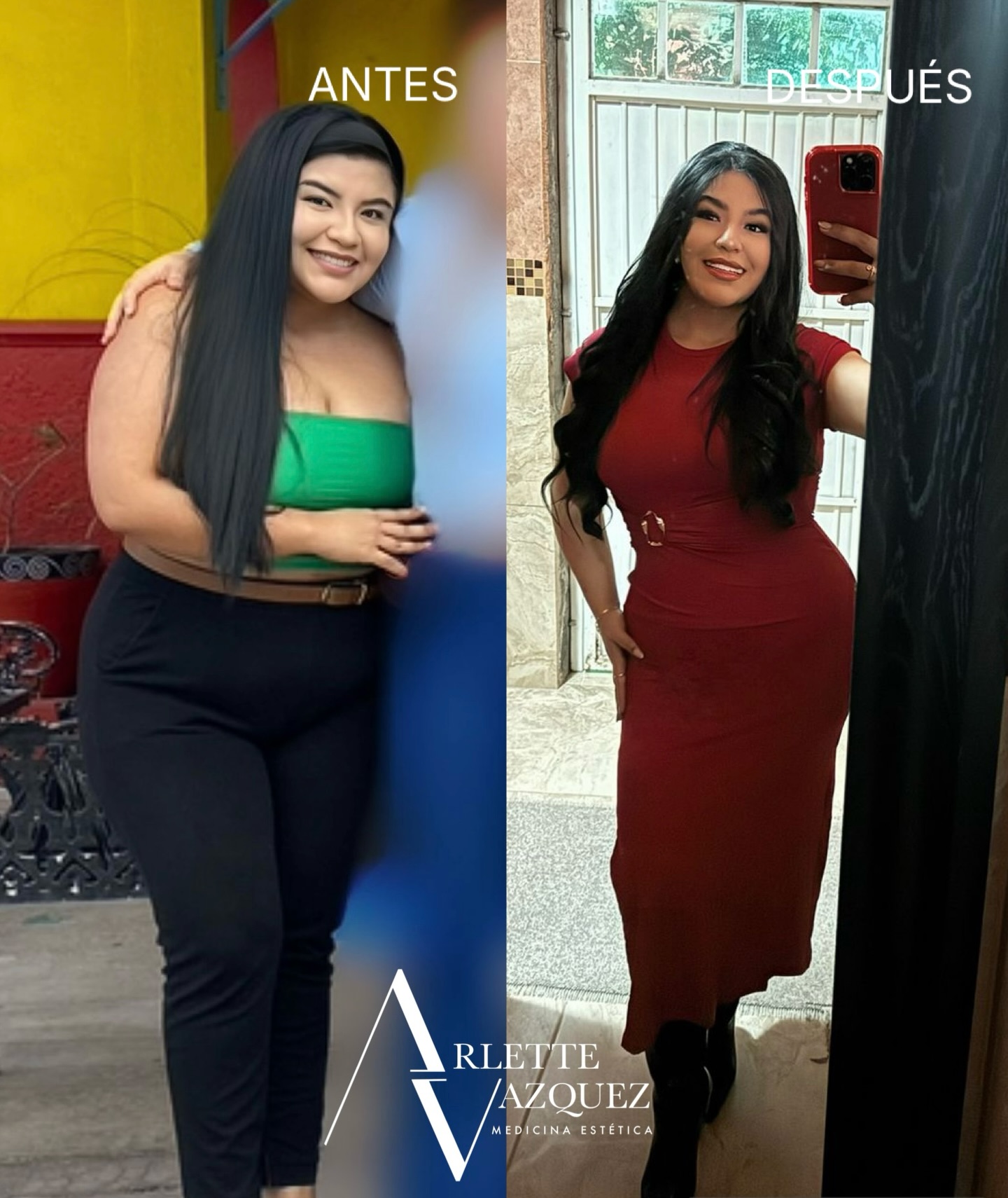 tirzepatide resultados vs Semaglutide: Comparacin Clnica 2026 Tirzepatide versus Semaglutide Once Weekly