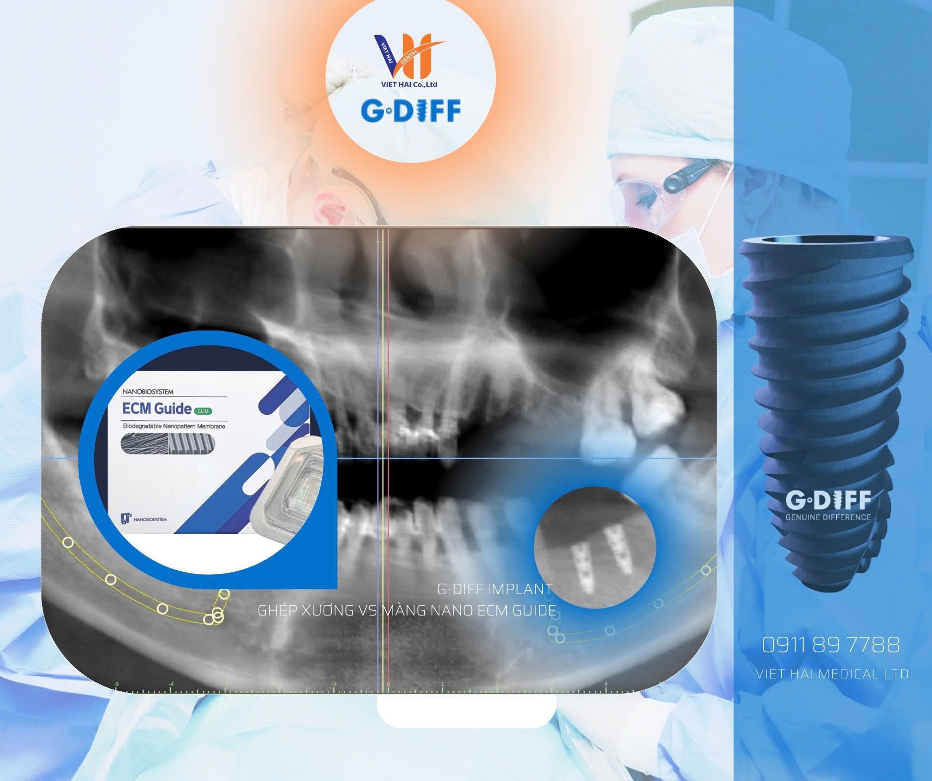 IB G-Diff Implant Vietnam