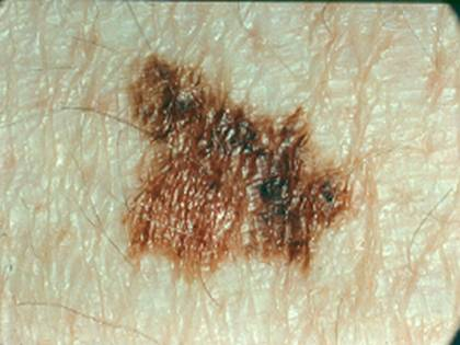 lipo c with b12 with tirzepatide Hutchinson sign Archives main image 1
