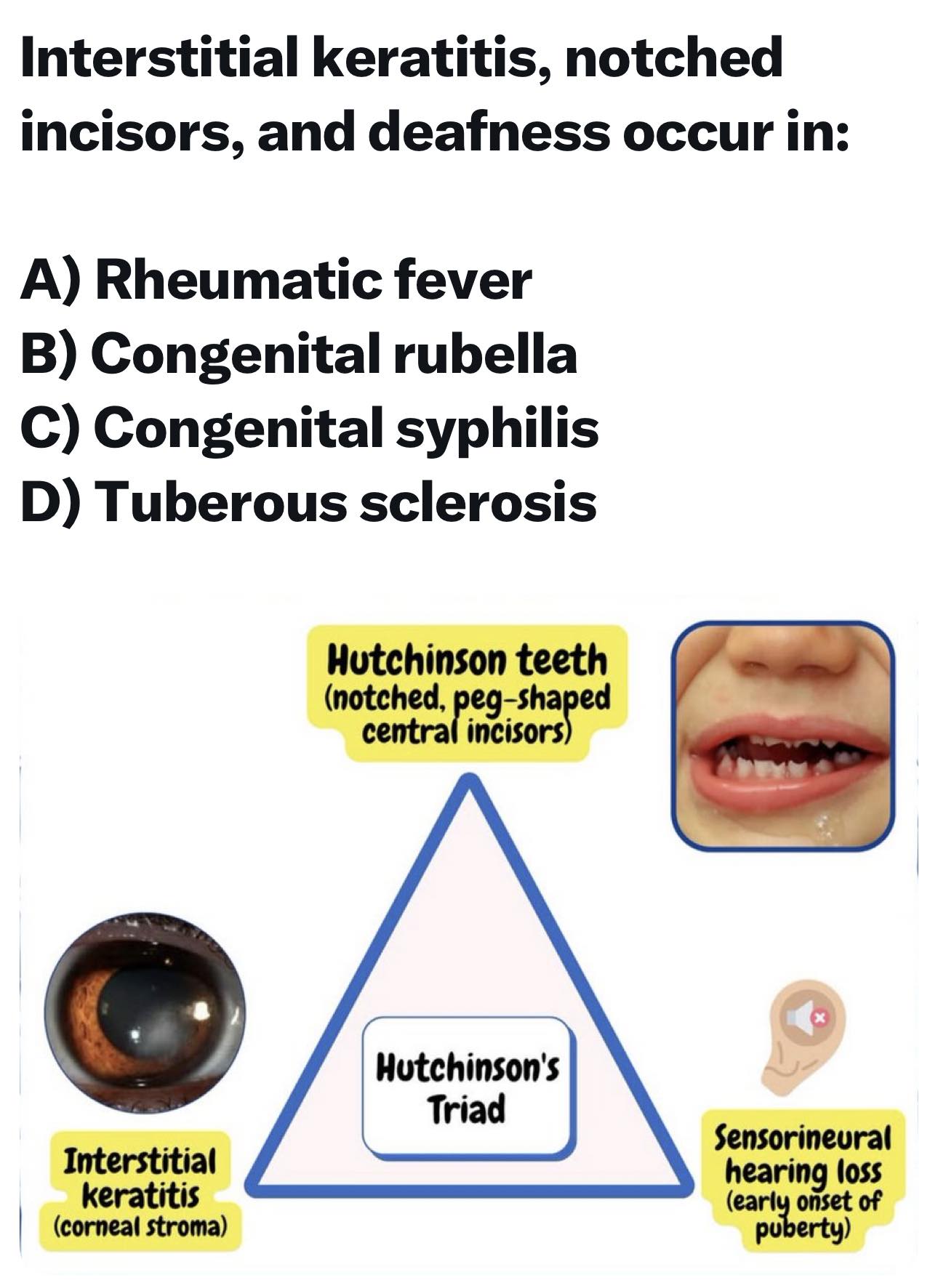 Interstitial keratitis, notched incisors, and deafness occur in: | Facebook