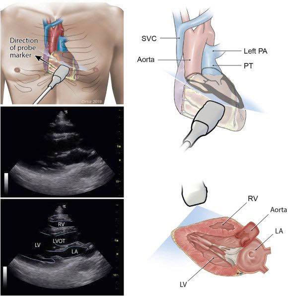 Cardiophilia - 1️⃣ Parasternal Long Axis (PLAX) - Patient Position ...