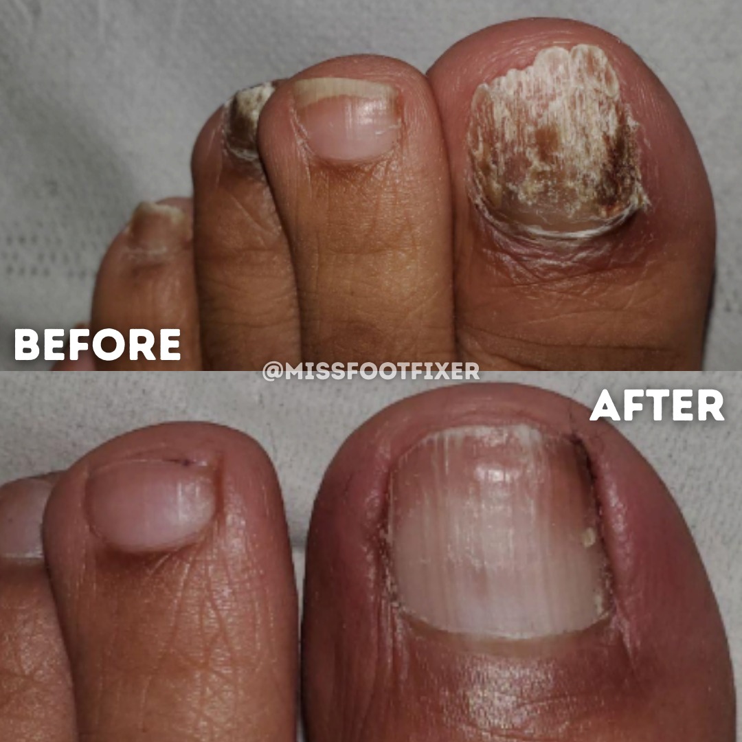 Miss Foot Fixer - Before & After: Fungal Toenail... | Facebook