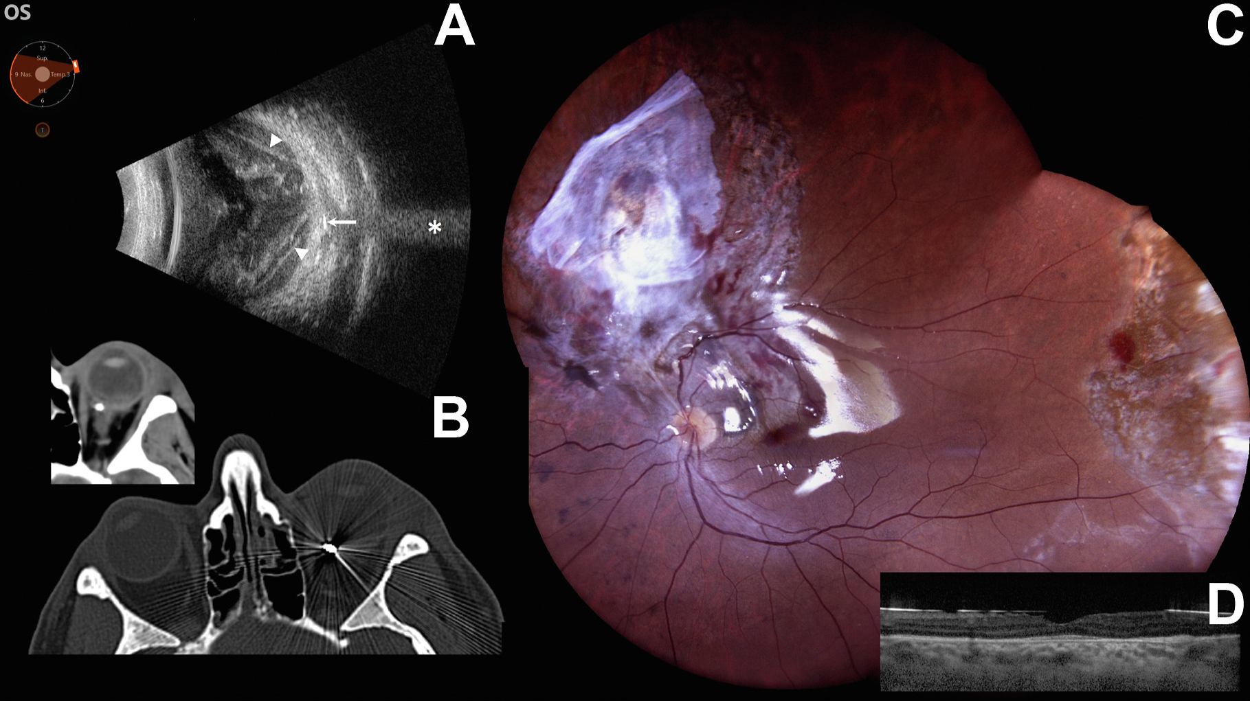 American - A 48-year-old man presented with funnel-shaped retinal ...