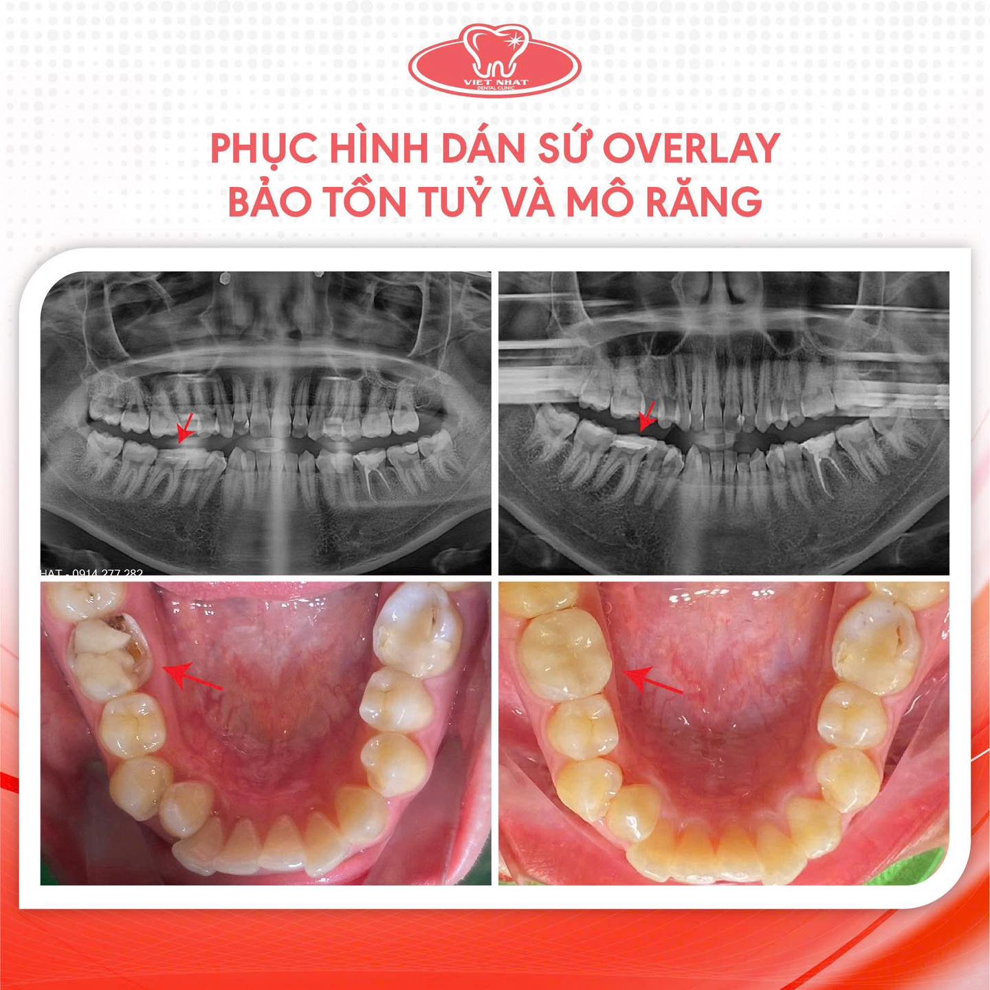 Phòng - ️PHỤC HÌNH DÁN SỨ OVERLAY – GIẢI PHÁP BẢO TỒN RĂNG THẬT TỐI ƯU ...