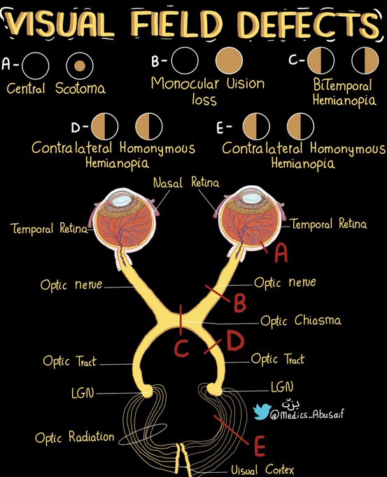 Newyifan - Informative diagram of visual field defects. | Facebook