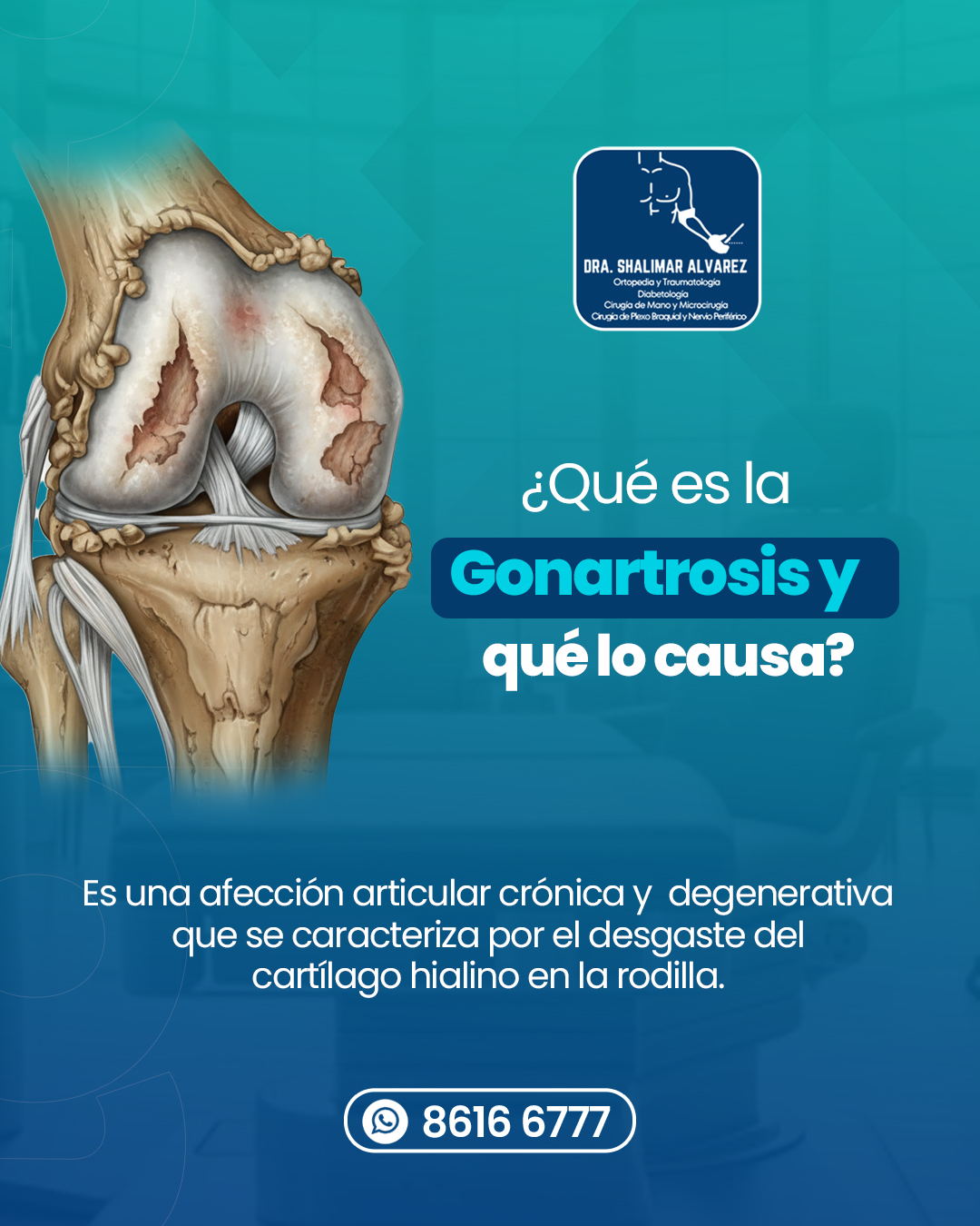 Dra. - 🌟 ¿Sabías que la gonartrosis afecta la rodilla? 🌟 La gonartrosis ...