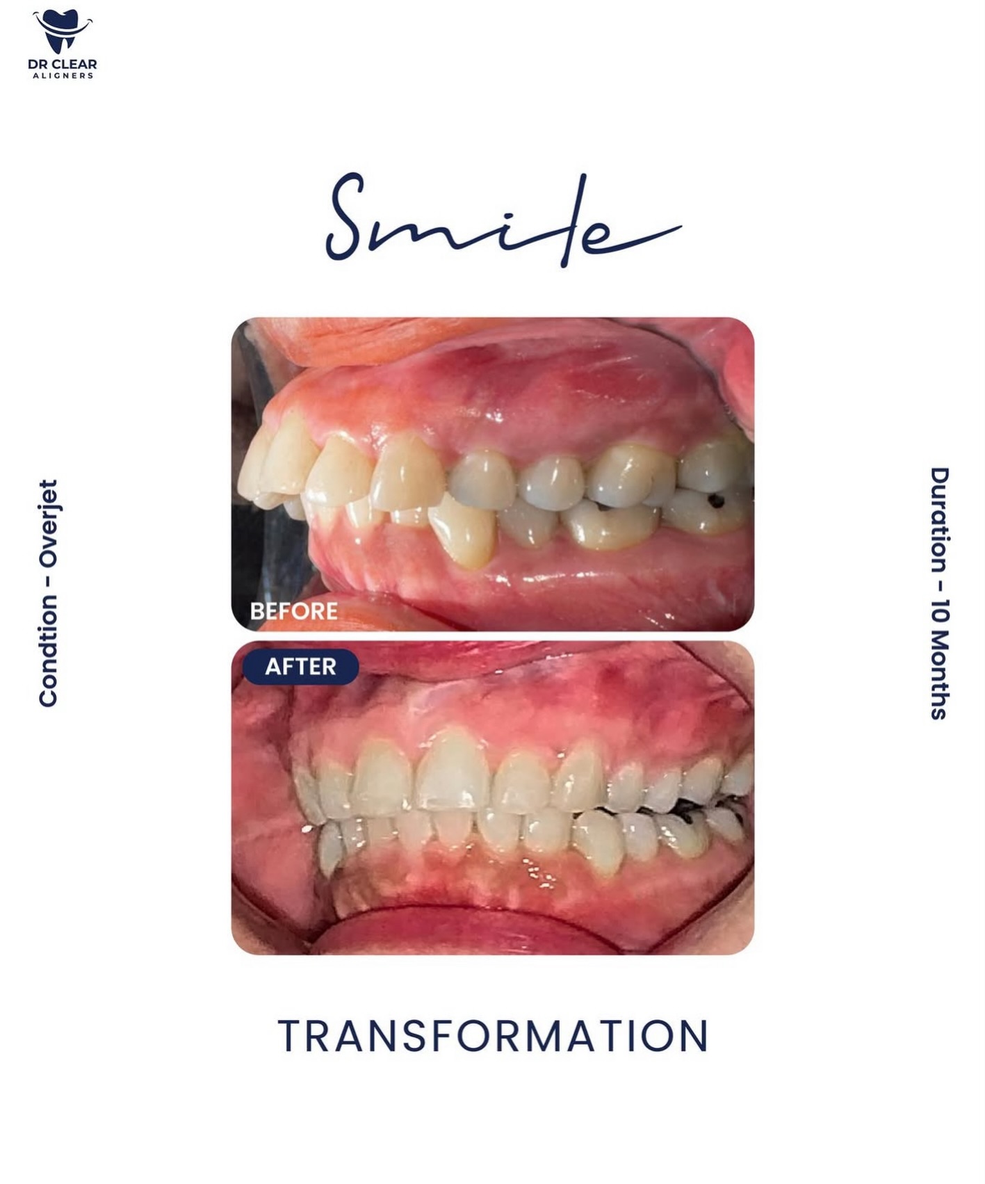 Elevate your smile with our... - Dr Clear Aligners Australia | Facebook