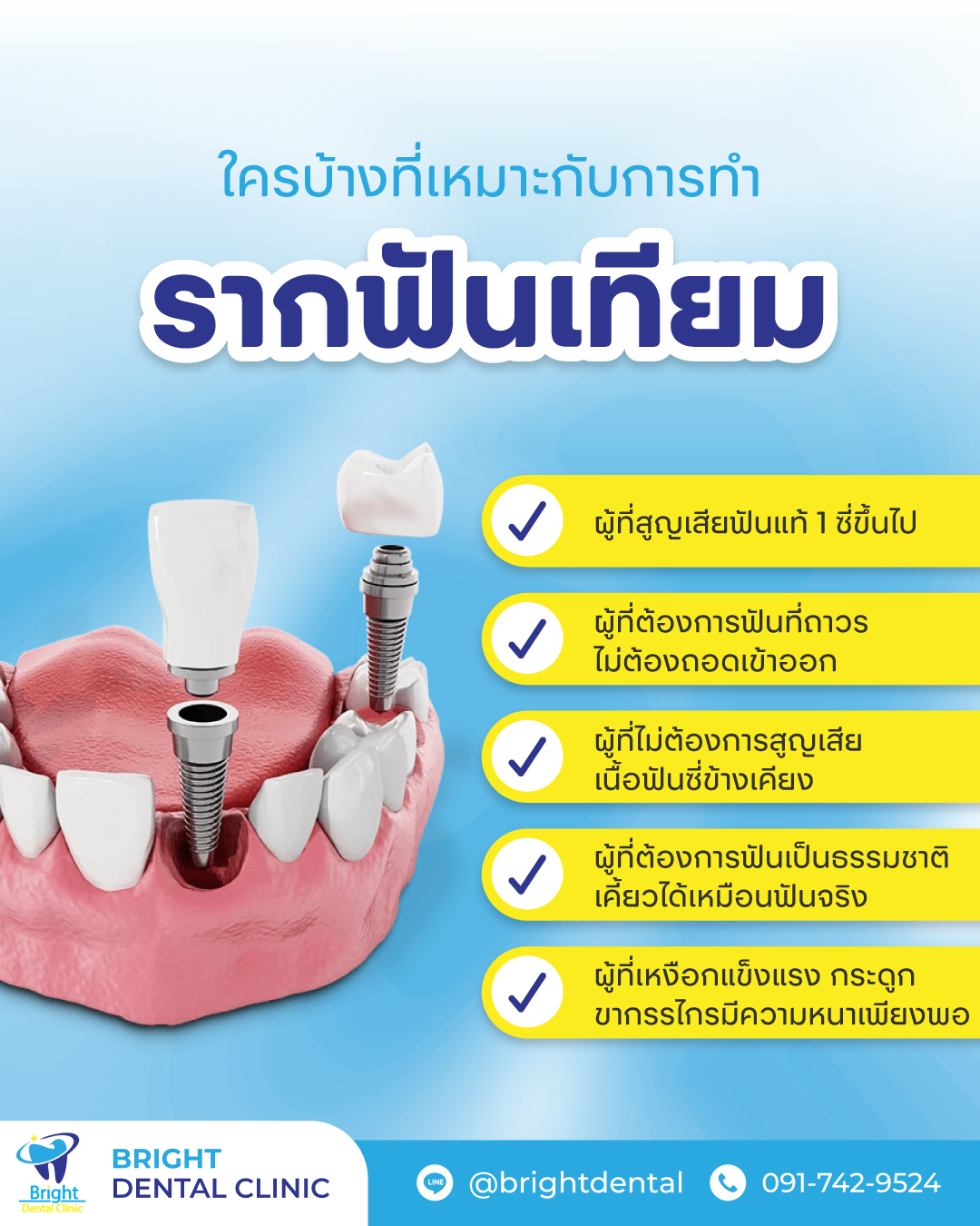 ใครบ้างที่เหมาะกับการทำ รากฟันเทียม 🦷 ผู้ที่สูญเสียฟันแท้ 1 ซี่ขึ้นไป ...