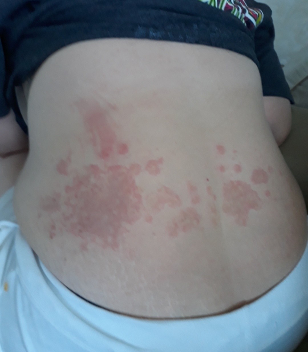 Does anyone else have this from Lyme? I have all three “B's” and malaria