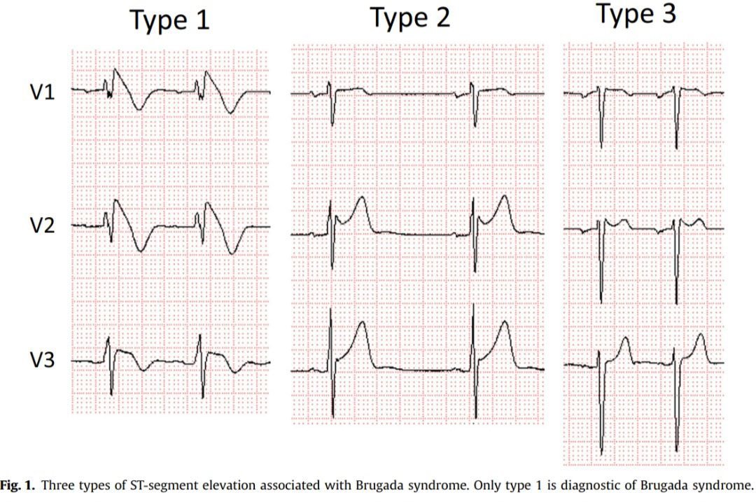 The J Wave (Osborn Wave): J wave, an extra deflection at the QRS
