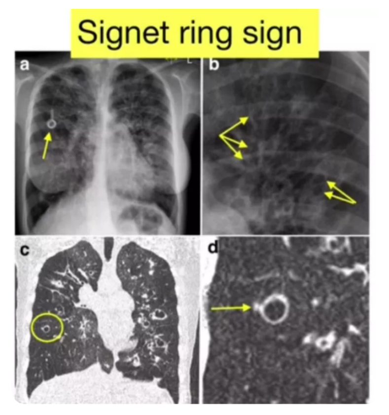 Respiratory - What does this sign indicate? | Facebook
