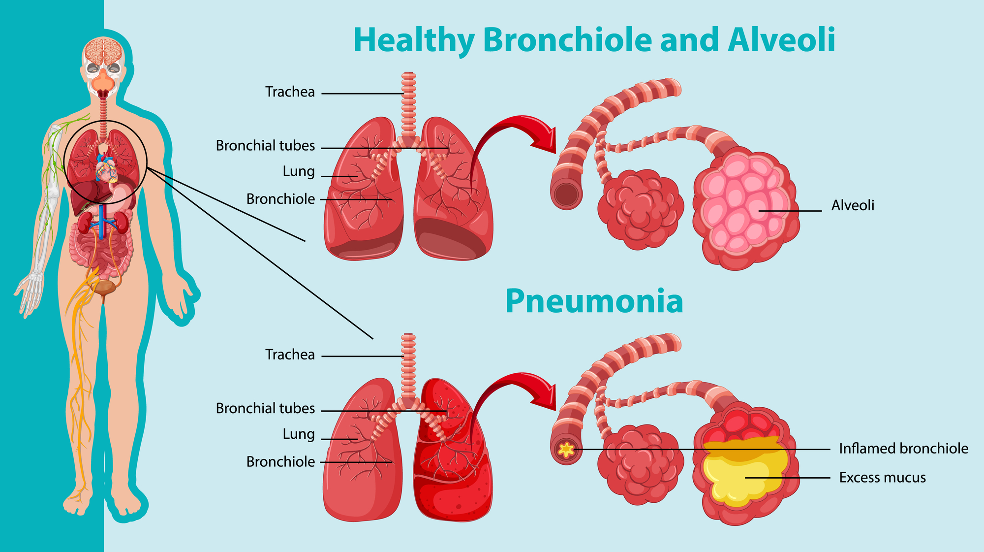 Respiratory - Healthy alveoli are tiny air sacs in the lungs where ...