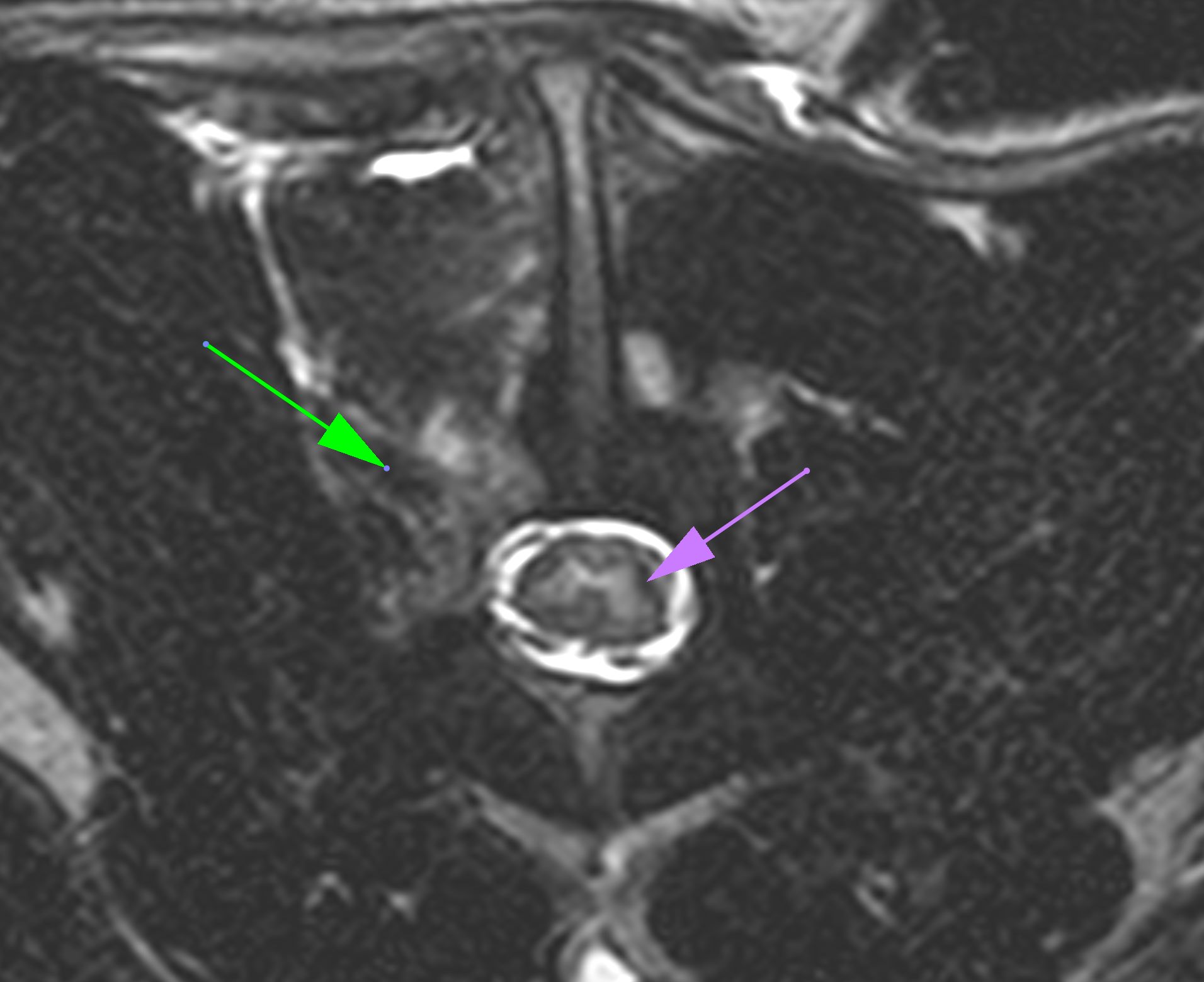 POLIOMYELOMALACIA FOLLOWING... - Veterinary Neurology