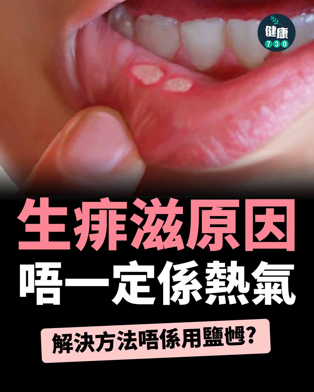 am730 - 生痱滋（又稱復發性口瘡）時痛不欲生，不但刷牙痛、食飯會痛，甚至飲水都會痛，不少人以為痱滋是因為食太多煎... | Facebook