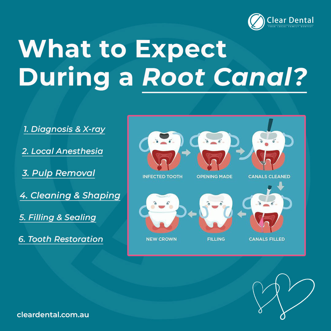 Clear - Worried About Getting a Root Canal? Here’s What to Expect. Root ...