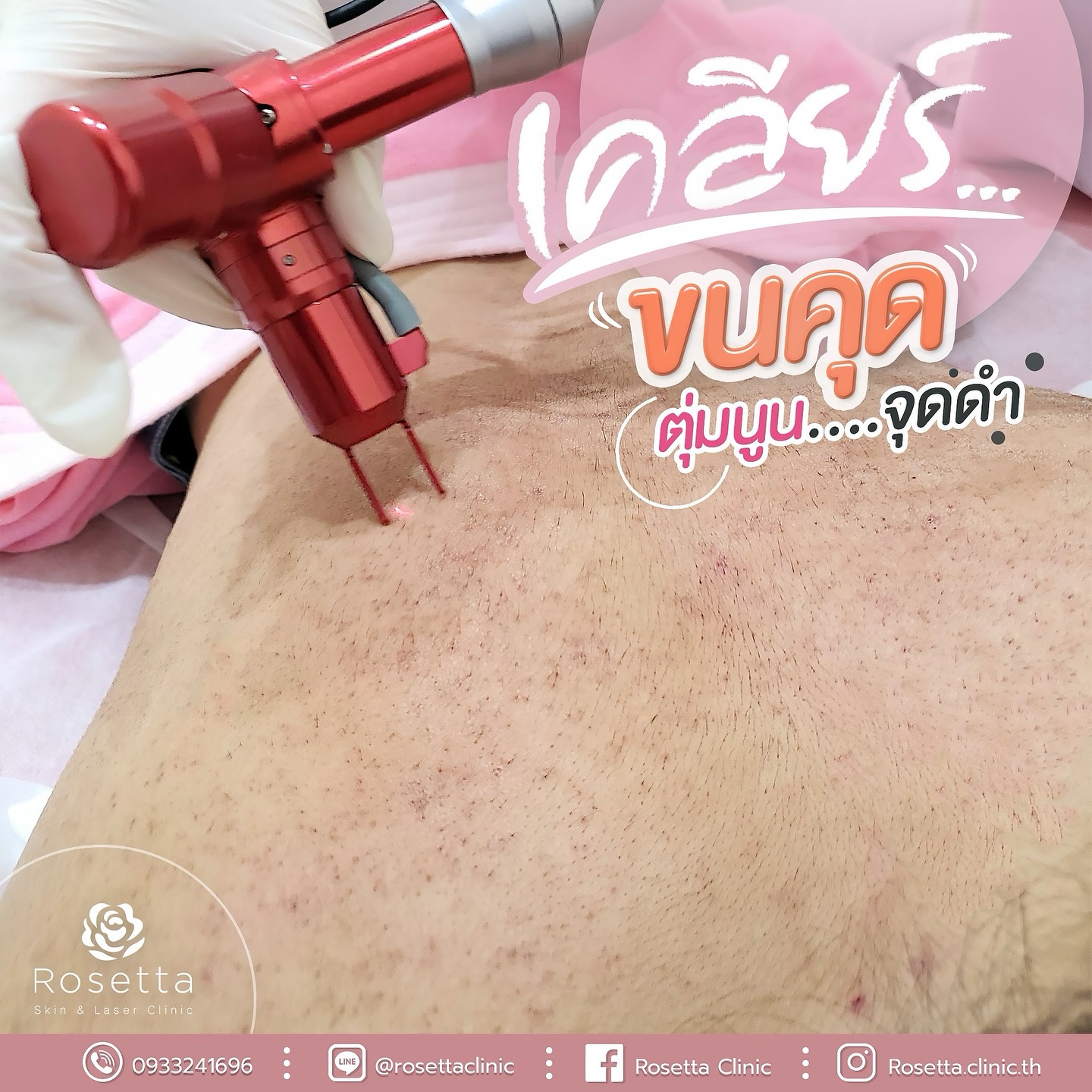 Rosetta - ️ทาครีมยังไงก็ไม่หาย อยากให้ลอง!! 👉เลเซอร์ขนคุด เหมาบริเวณ ...