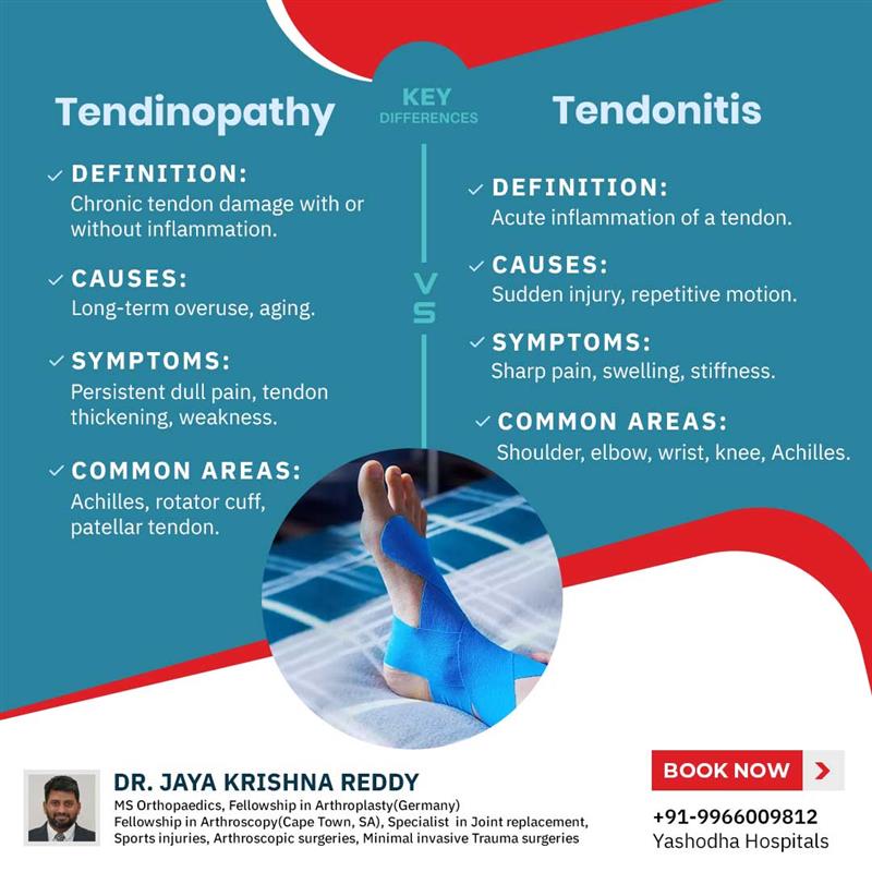 Dr.Jaya - Tendinopathy and tendonitis are often used interchangeably ...