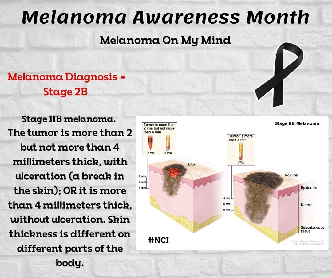 Melanoma - 🖤Melanoma Awareness Month🖤 Stage 2 ~ 👉 Stage IIB melanoma ...