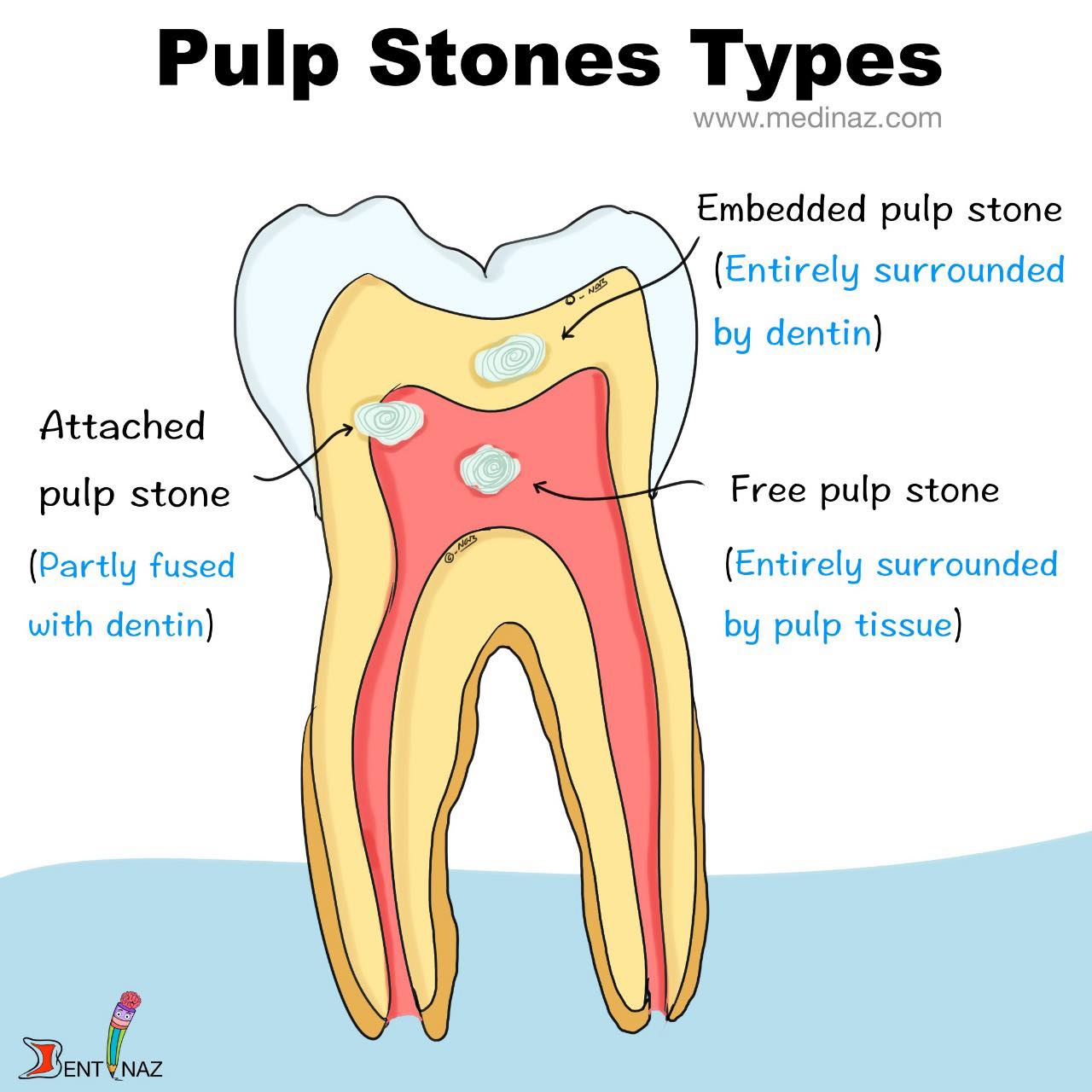 Dental - Pulp stone types | Facebook
