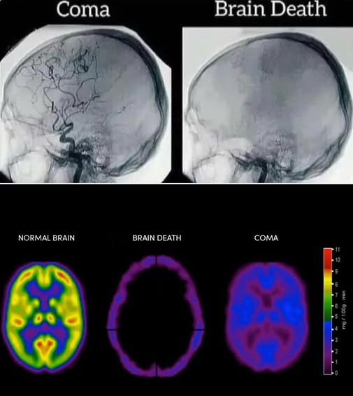 Life - 🧠 Coma vs. Brain Death — What’s the Difference? ⚠️ This ...