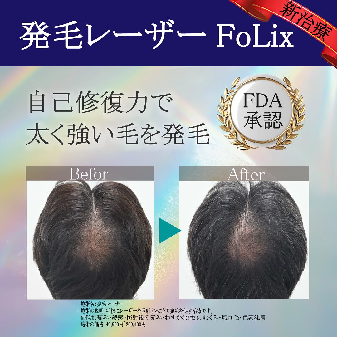 レーザー 発 毛