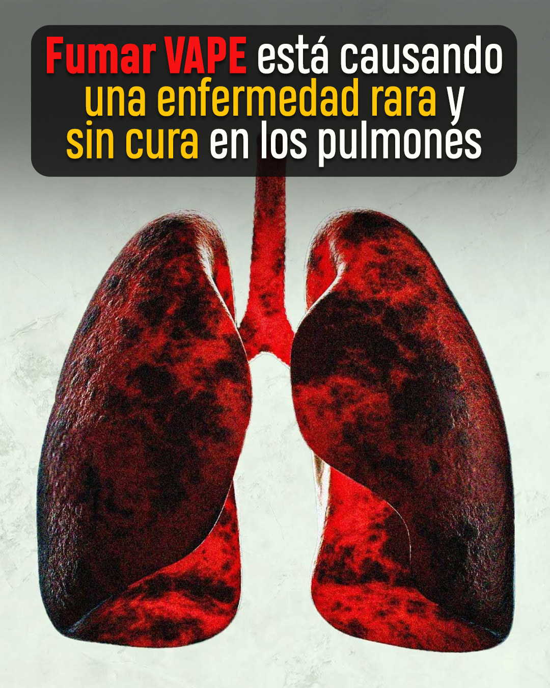 el vape sale en el antidoping de sangre A una mujer Ohio le acaban sacar 2 litros de un líquido negro y con directamente de los pulmones. Sí, dos litros. ¿Y sabes qué era ese líquido? Jugo XROS 4 Nano Choose Flavor:Peach Dive Flavored Vapes in Ypsilanti,