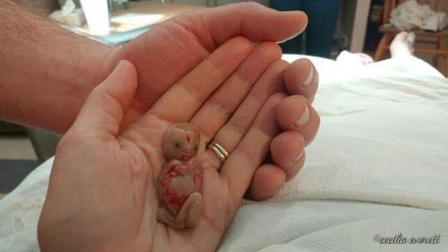 Dunia Mama Dan Si Manja Keguguran Berulang Ulang Punca Rawatan Apakah Keguguran Kehilangan Bayi Sebelum 24 Minggu Kehamilan Dipanggil Keguguran Jika Ianya Berlaku Pada 3 Bulan Pertama Kehamilan Dipanggil Keguguran