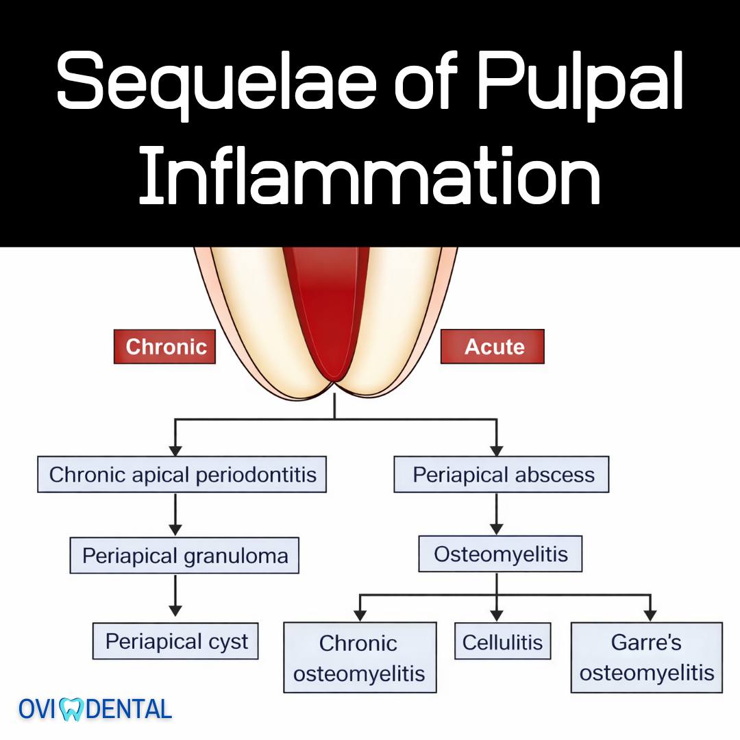 OVIdental - 🚫 Sequelae of Pulpal Inflammation: From Chronic Apical ...