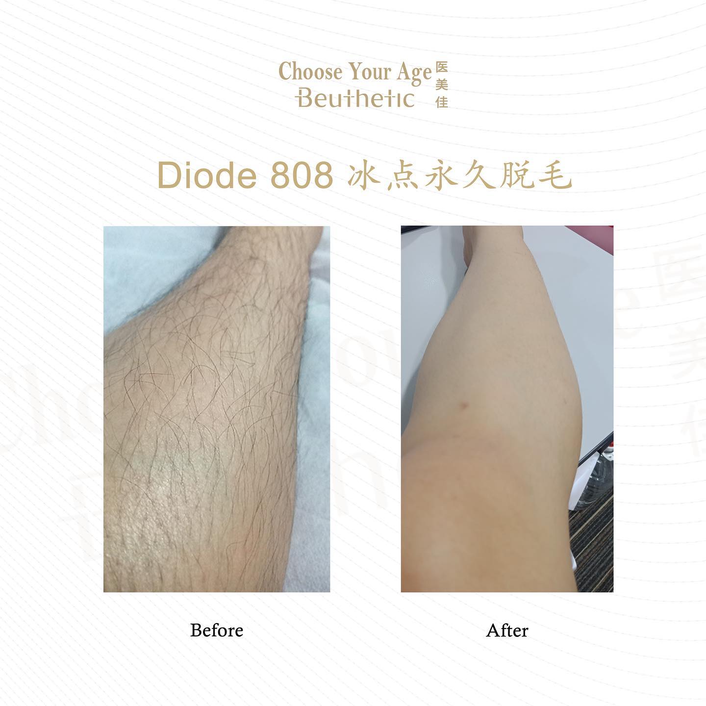 Beuthetic医美佳 毛发除不净 春风吹又生 您是否也尝试过使用了镊子 剃刀 蜜蜡贴片 脱毛 膏等各种方法呢 但在亲手除毛的过程中 大家也应该经历过不少弄痛自己的事故 又或是过于粗暴而导致毛孔越发粗大就像鸡皮一样