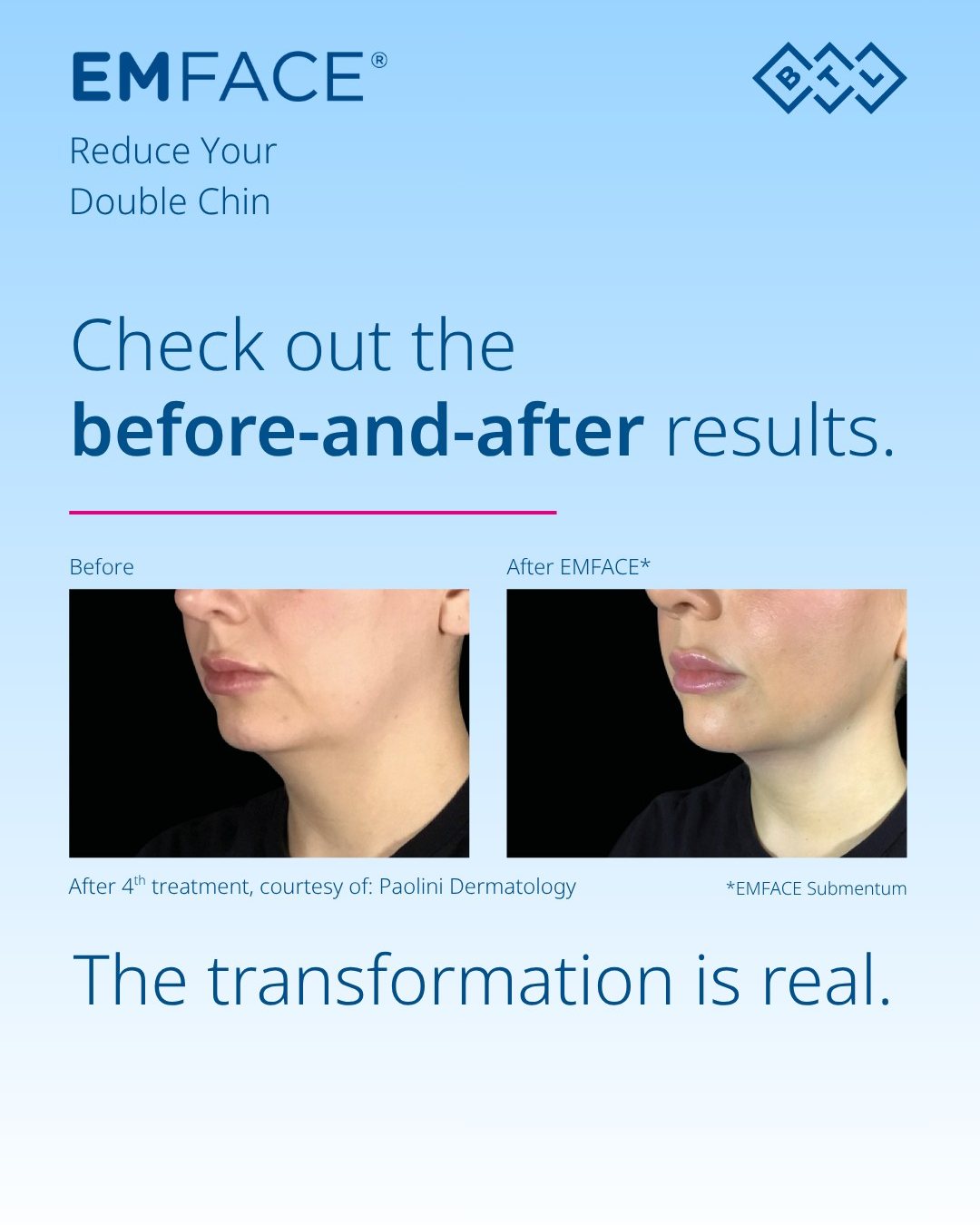 BTL Aesthetics - See the results EMFACE Submentum can... | Facebook