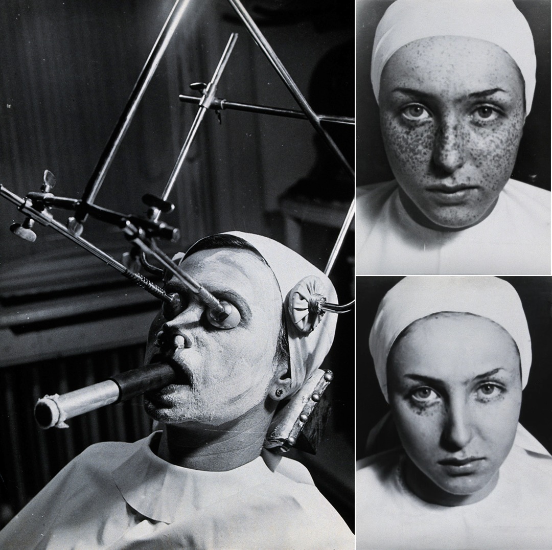 Life - 📷 When Beauty Meant Restraint — Freckle Removal in the 1930s ...