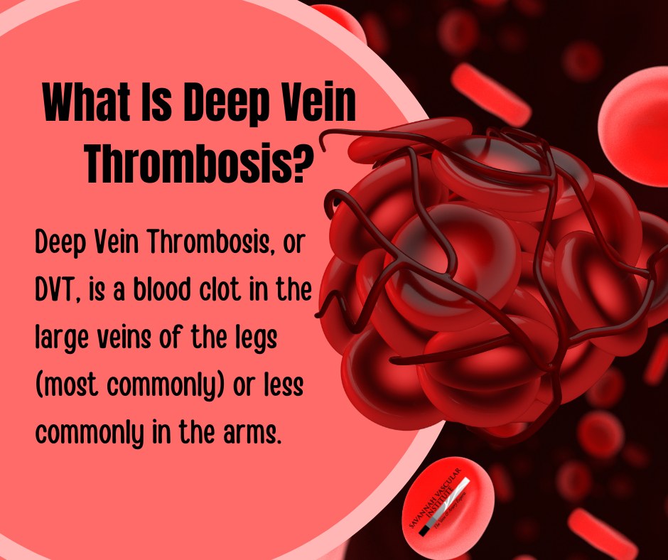 Savannah - Deep Vein Thrombosis, or DVT, is a blood clot in the large ...