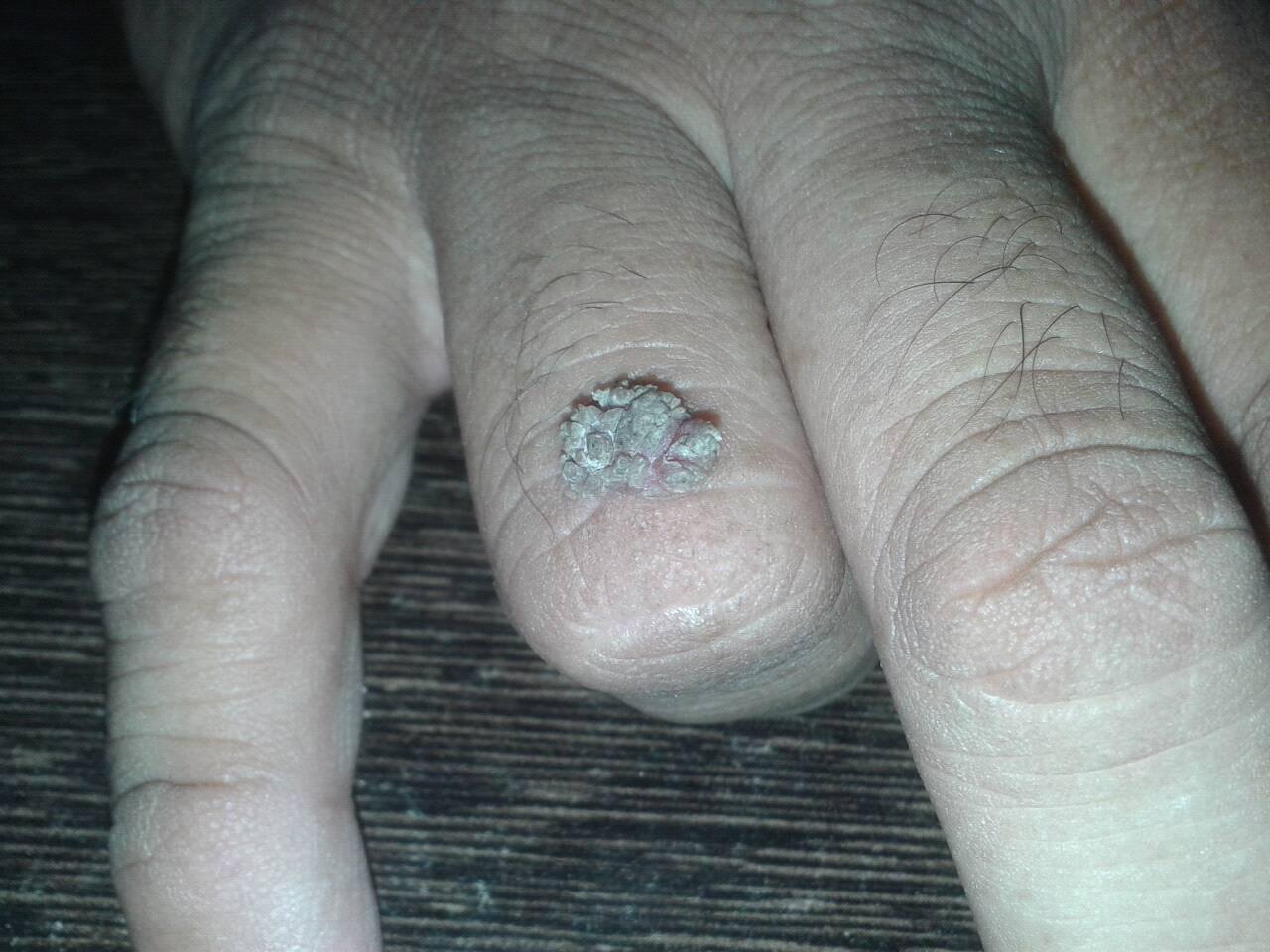 Medicine OPD: 1. Name the sign. 2. What disease he may have?