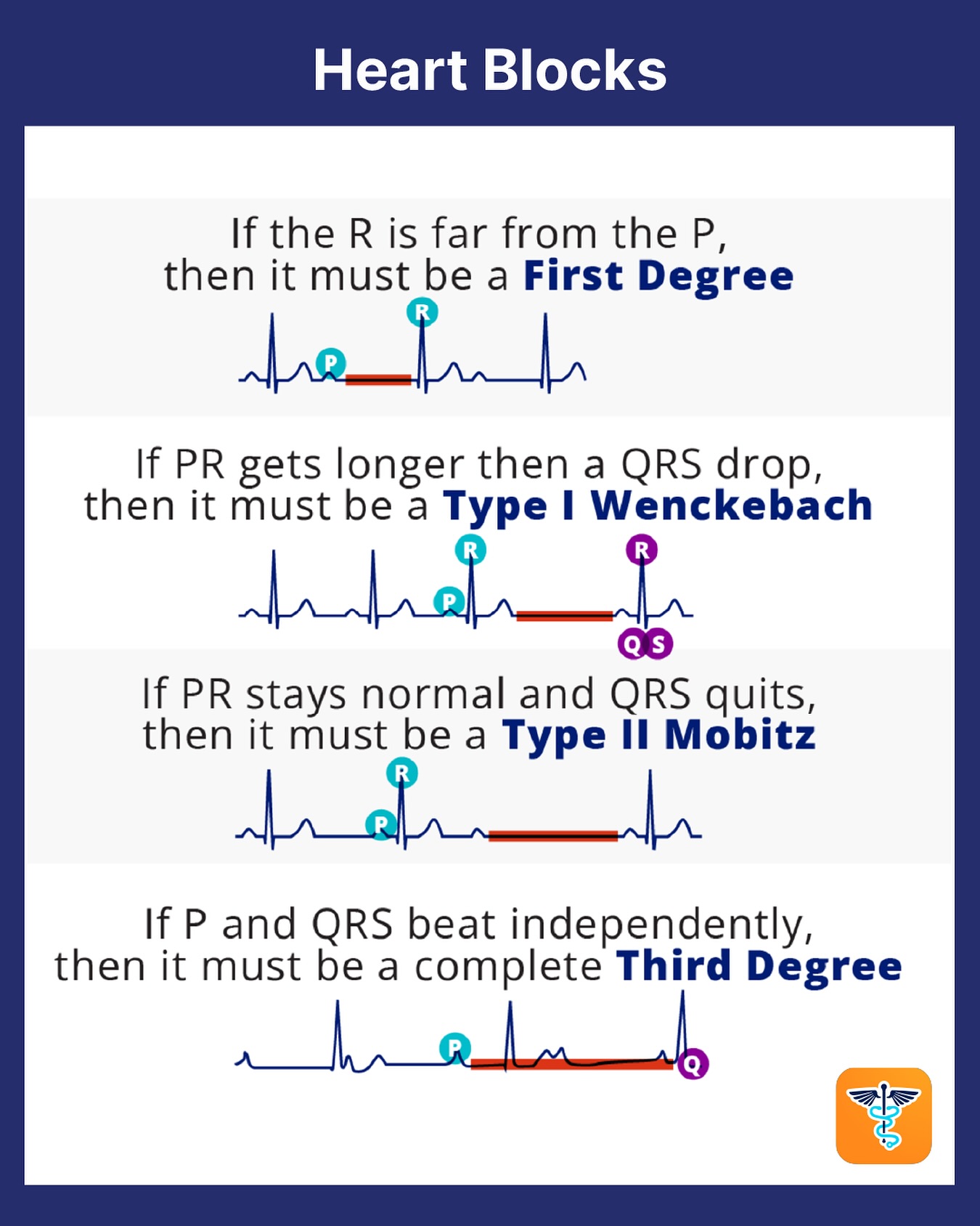 Nursing - 🫀 Mnemonic Monday: Heart Block Edition Trying to keep your AV ...