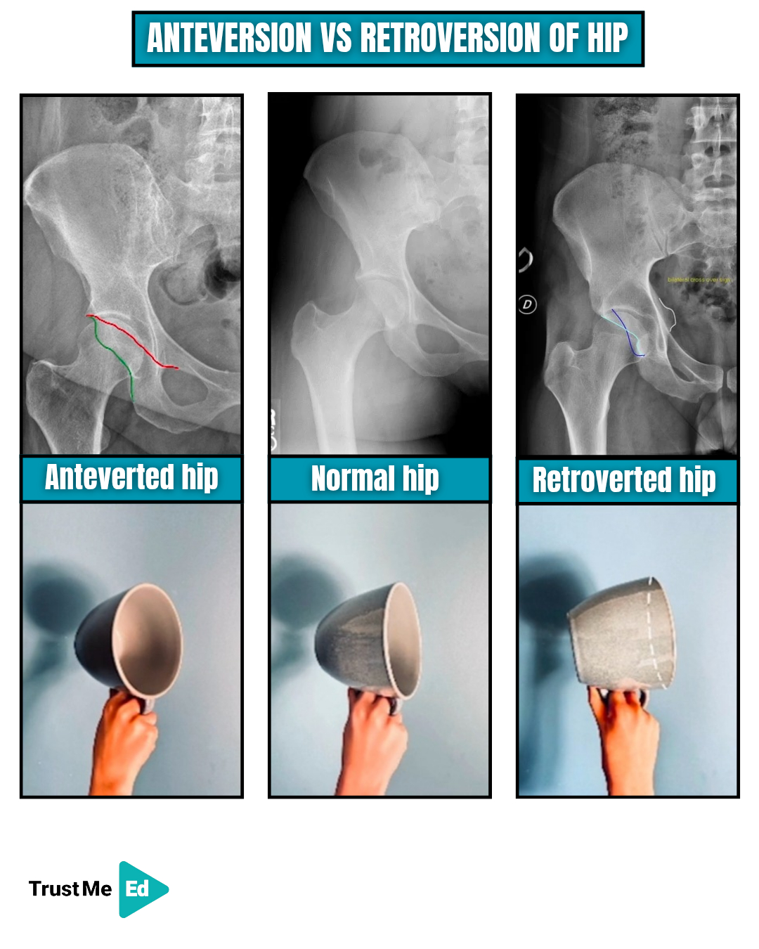 Trust - Not all hips are built the same.⁠ ⁠ Anteversion and ...
