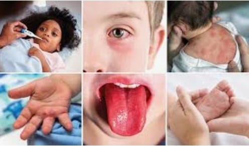 Multisystem Inflammatory Syndrome in Children or MIS-C strikes after a COVID-19 infection. It can cause inflammation to organs including the heart, lungs, kidneys, and brain
