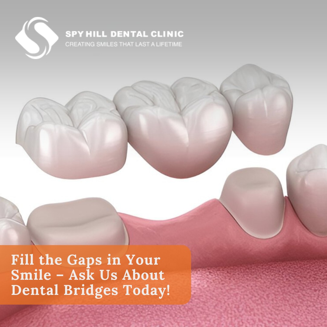 Replace Missing Teeth with a... - Spy Hill Dental Clinic | Facebook