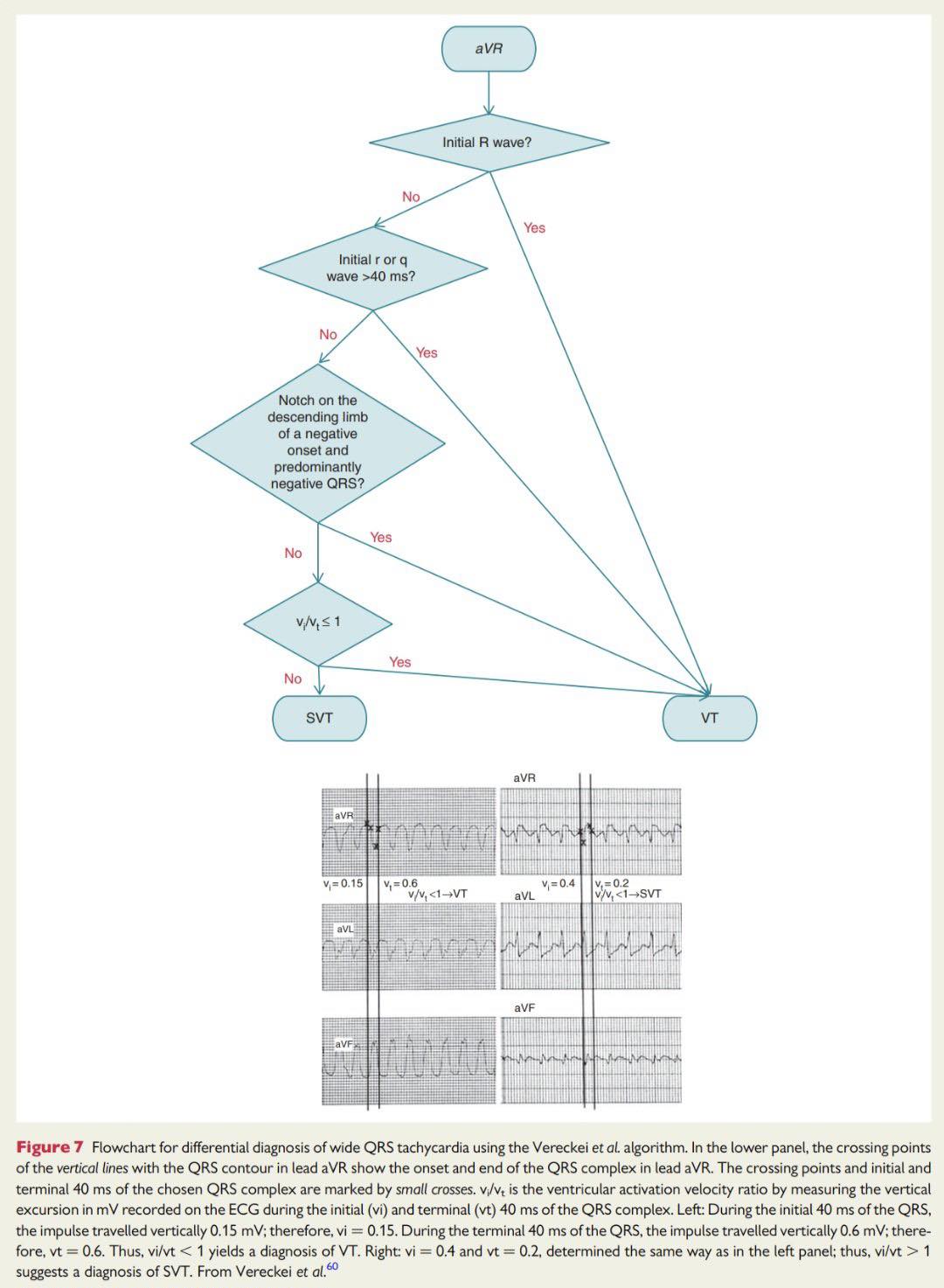 Cardiophilia - Vereckei algorithm to identify ventricular tachycardia ...