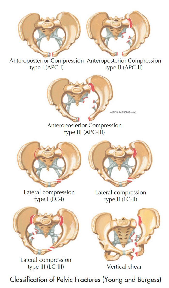 Classification of Pelvic Fractures... - Professor M. A. Imam | Facebook
