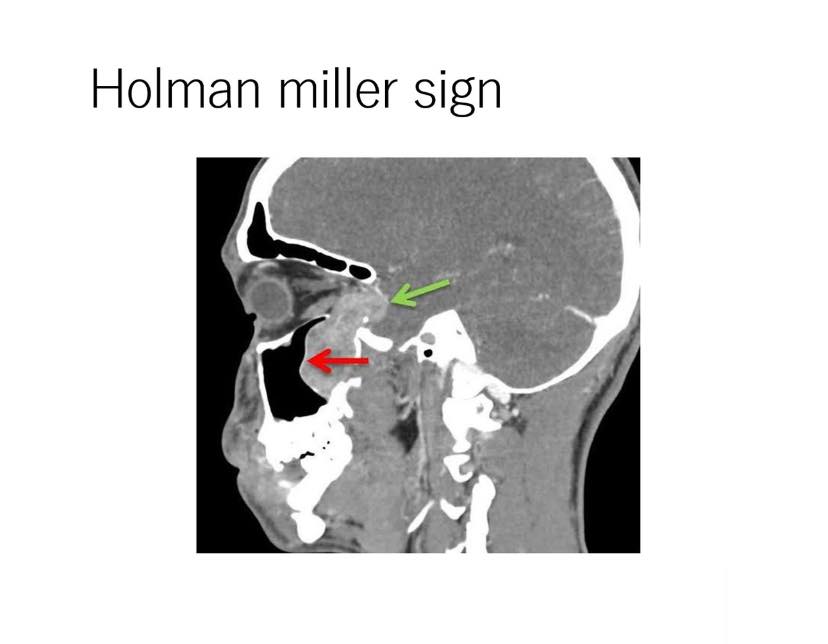 Cardiophilia - 💎Very useful reminder! 💎 👨‍🏫Holman-Miller sign ...