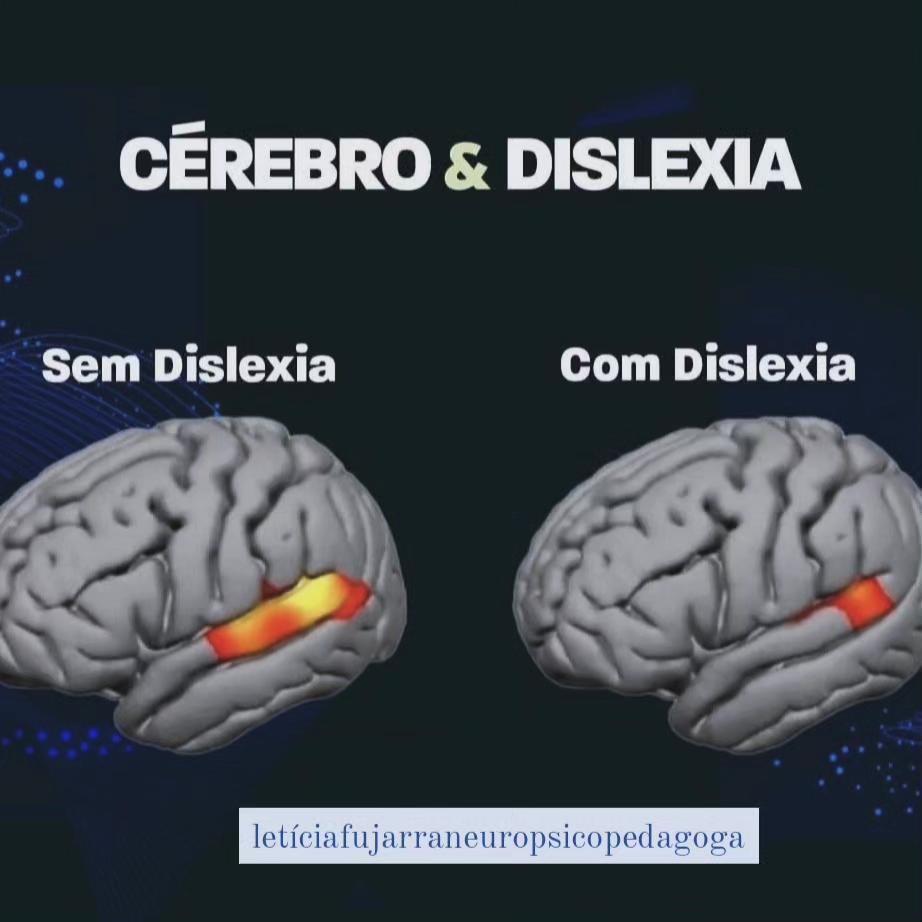 Letícia - O que é dislexia? A dislexia é um distúrbio genético que ...