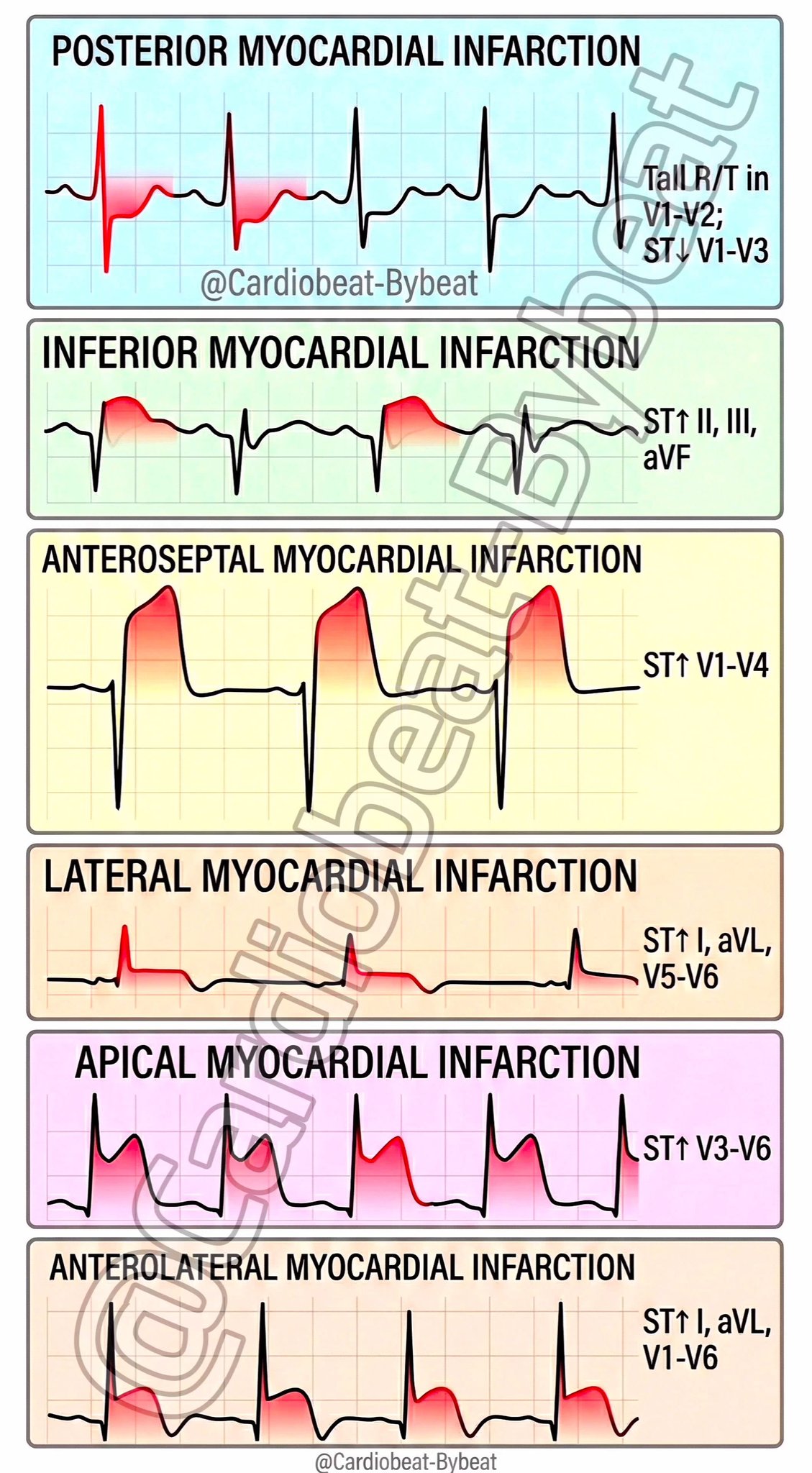 Findings: General EKG Changes suggestive of Acute Myocardial