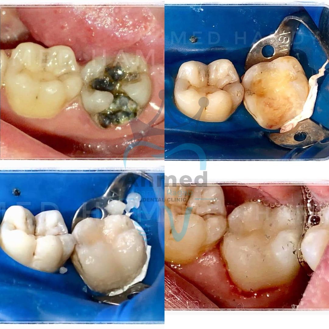 Dr. Ahmed Hamdy Ragab Dental clinic - ⭐ مين كان يصدق ان ضرس زي ده نقدر ...