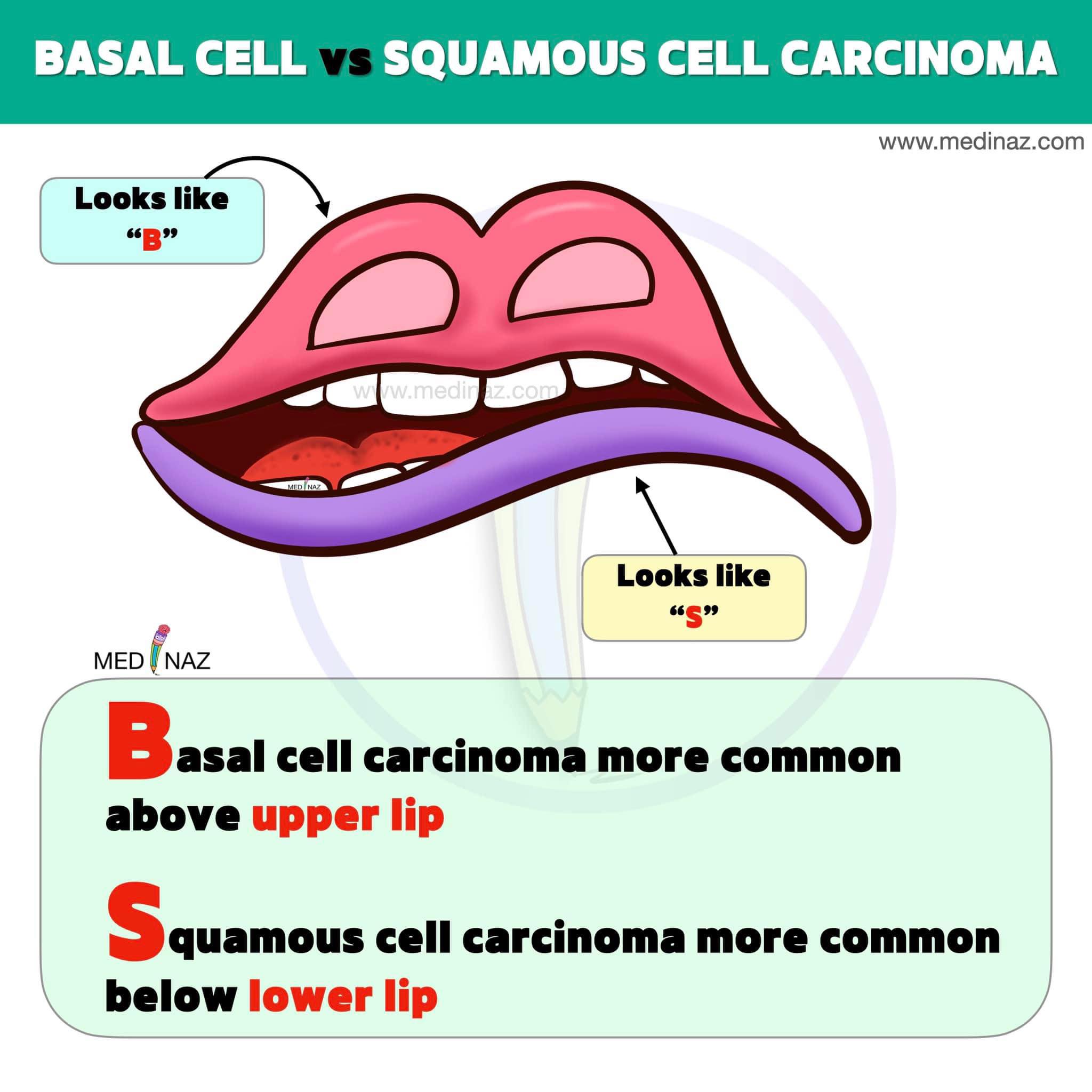 Medinaz - Basal cell Vs Squamous cell carcinoma | Facebook
