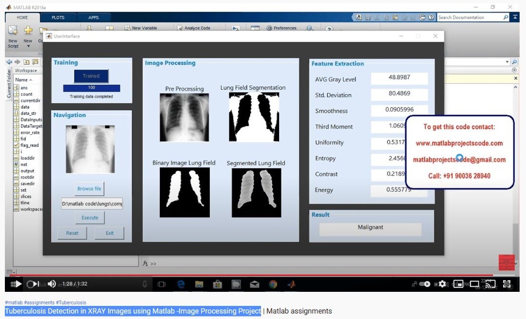 Tuberculosis Detection in XRAY... - Matlab Research projects | Facebook