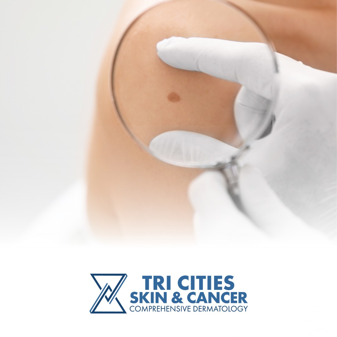 The Clinic - When checking your skin, remember the ABCDEs: - Asymmetry ...